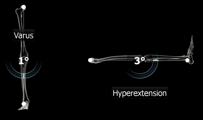 Врачи Прикамья впервые заменили коленный сустав с применением роботизированной системы
