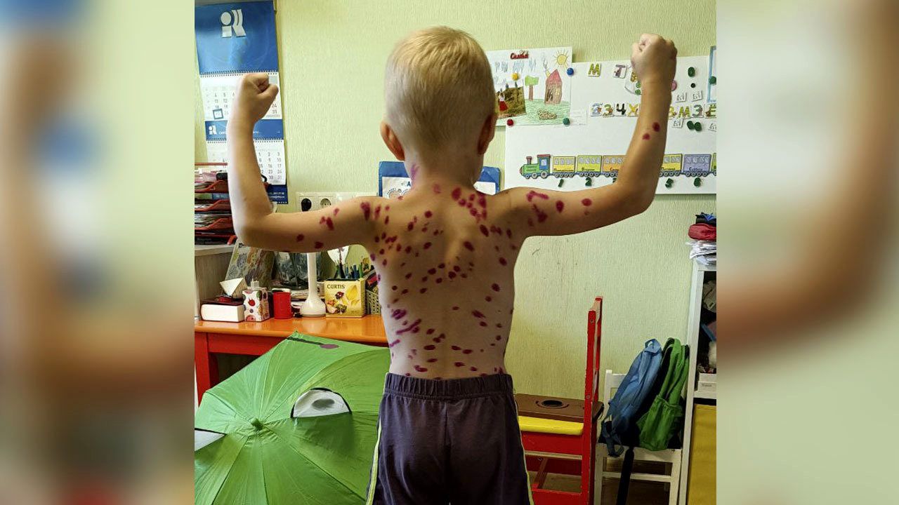 Не шутите с ветрянкой. От чего можно спастись, поставив прививку