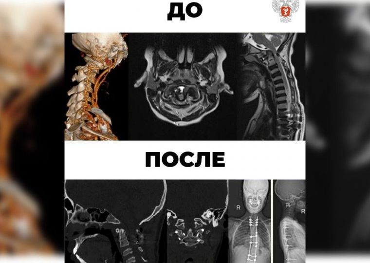 Специалисты федерального центра Минздрава России вернули способность ходить парализованному подростку из Перми