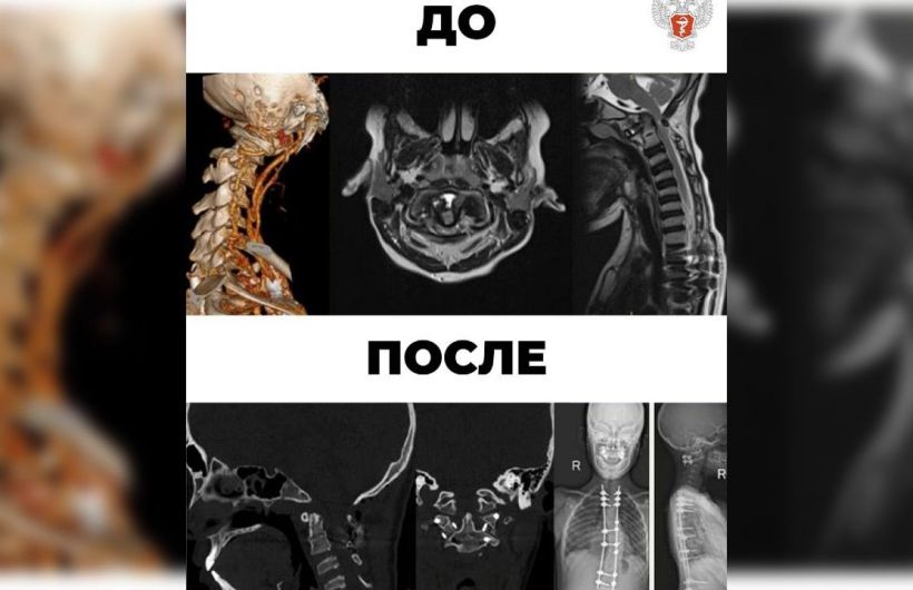 Специалисты федерального центра Минздрава России вернули способность ходить парализованному подростку из Перми
